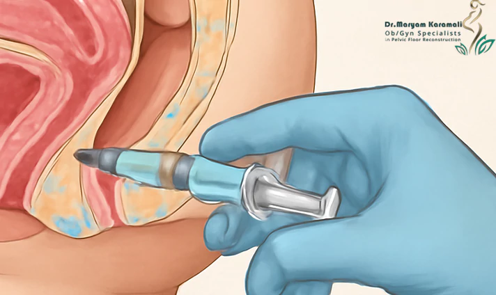 نحوه محاسبه هزینه تزریق ژل به واژن